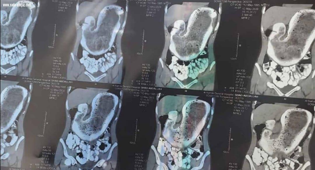 حالة نادرة.. 2 كيلو من الشَّعر داخل بطن فتاة بالطائف