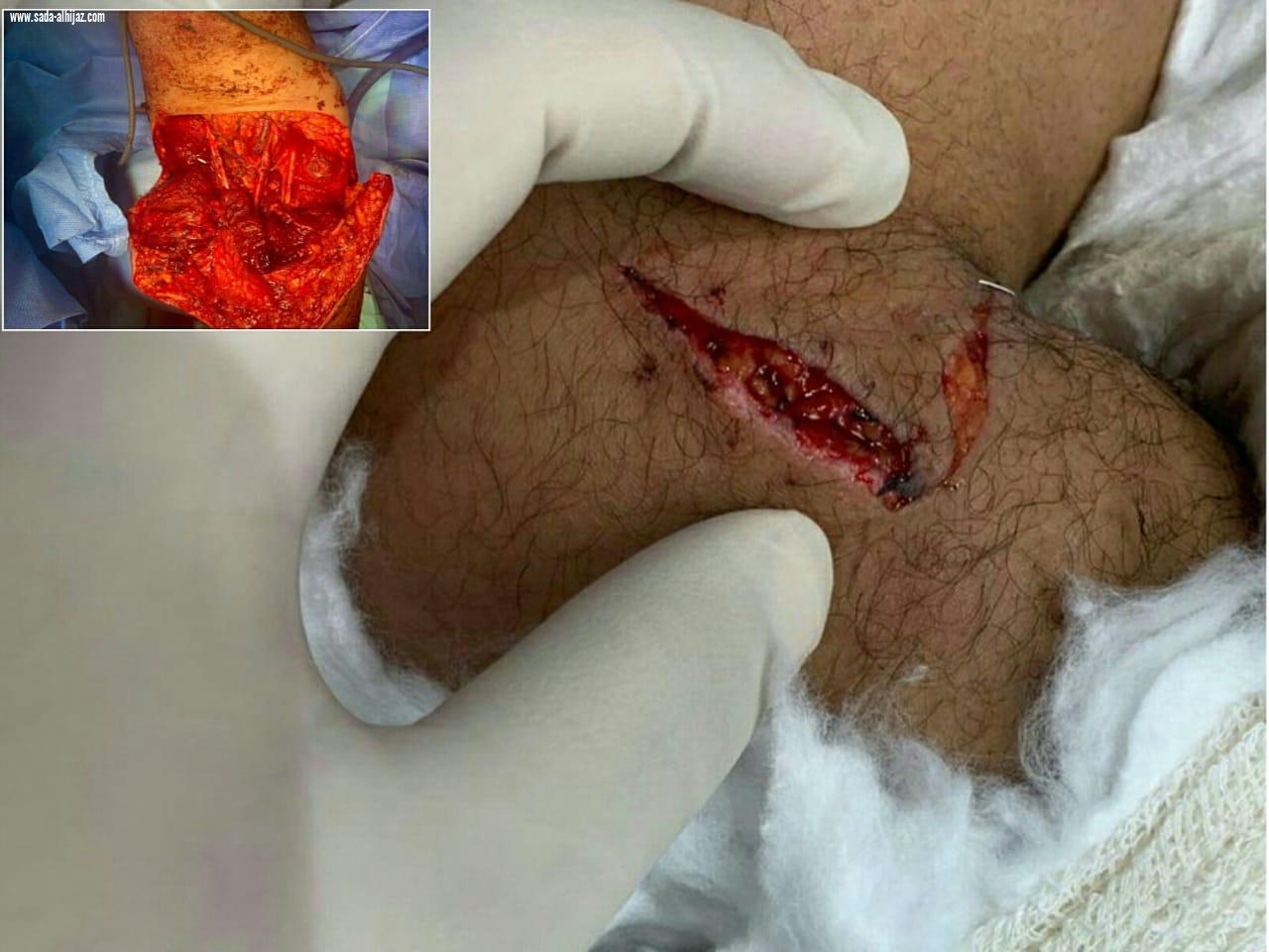 ثلاث فرق طبية بمجمع الملك عبد الله تساعد في إعادة ذراع أربعيني