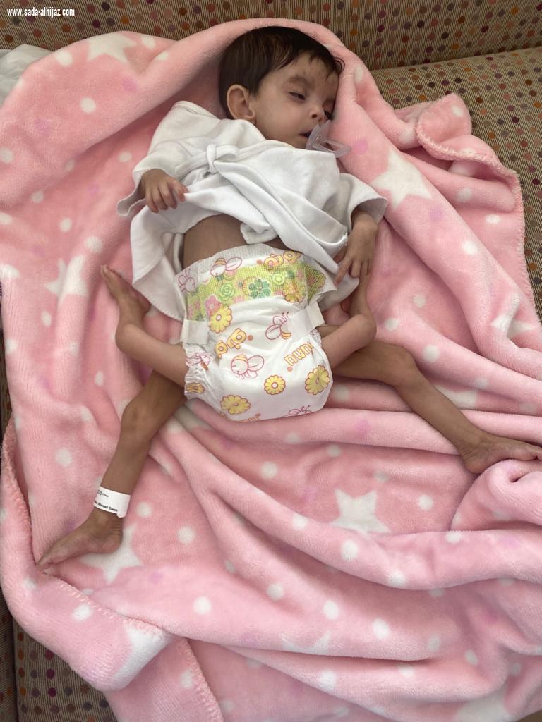 إنفاذًا لتوجيهات خادم الحرمين الشريفين.. إجراء عملية فصل التوأم الطفيلي اليمني عائشة غدًا